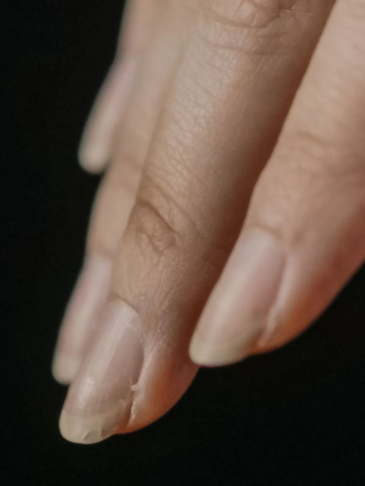 Gros plan sur quelques ongles qui se dédoublent au bord libre