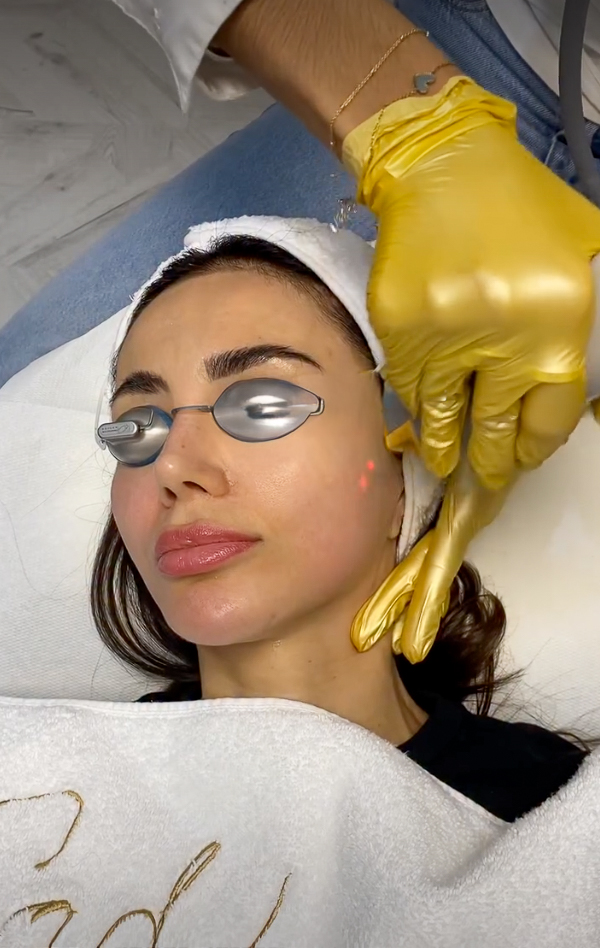 Fotorejuvenatie (IPL), IG @sadaf_jaffari | Treatwell