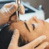 Close-up van een professionele microneedlingbehandeling op het gezicht van een vrouw in een salon